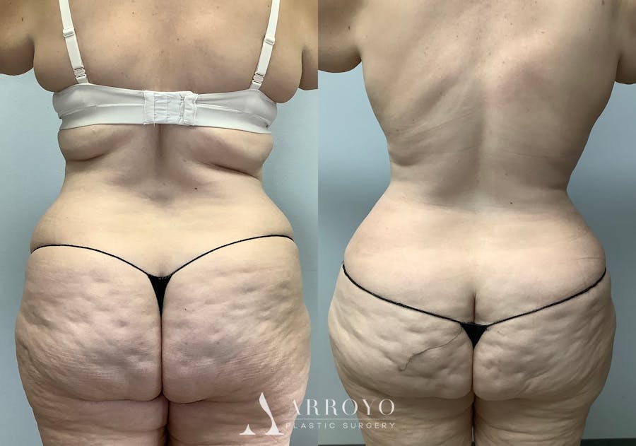 Tummy Tuck Before & After Gallery - Patient 147463773 - Image 6