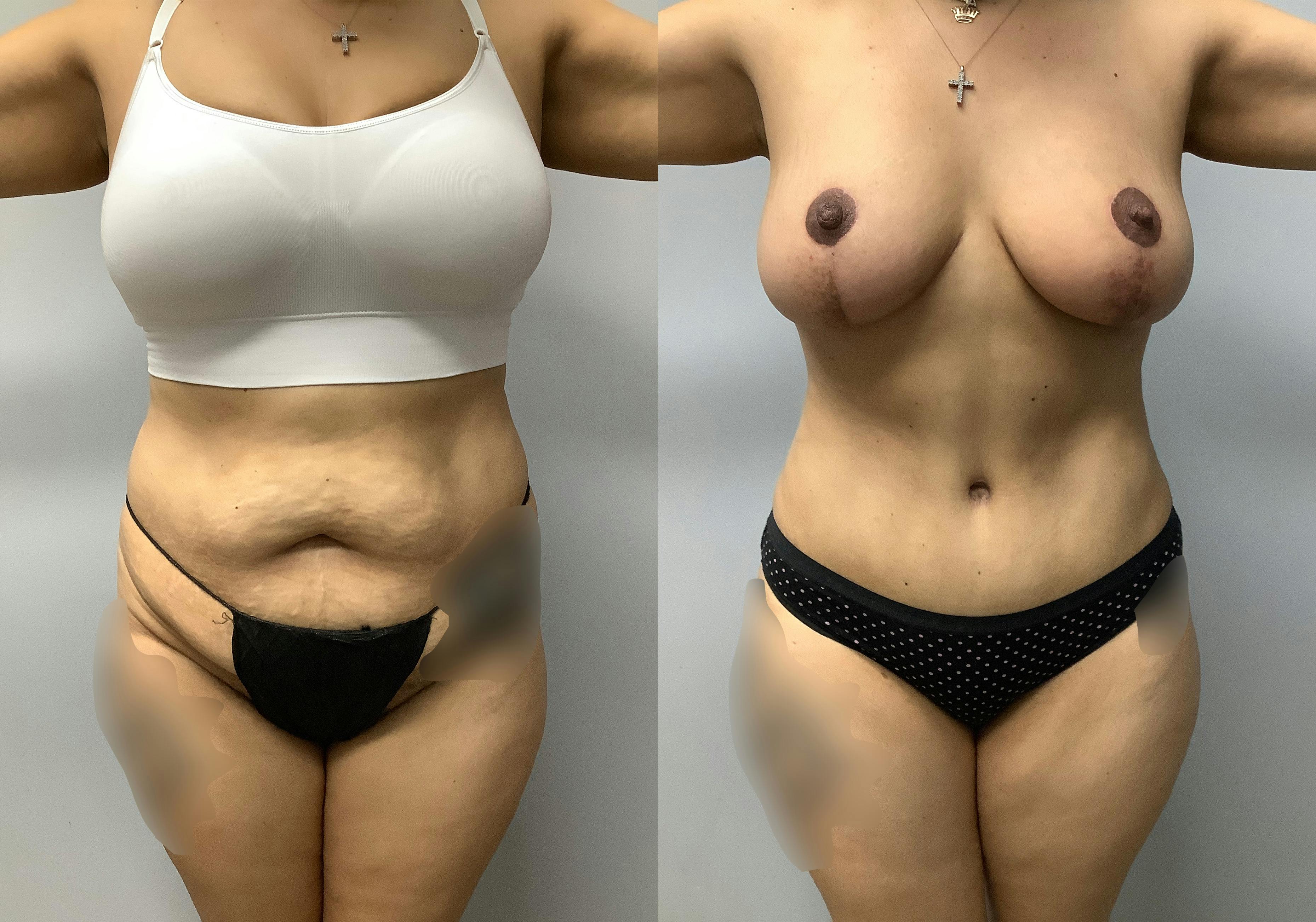 before and after of a Houston tummy tuck patient - 01