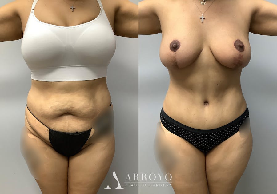 Tummy Tuck Before & After Gallery - Patient 147645231 - Image 1