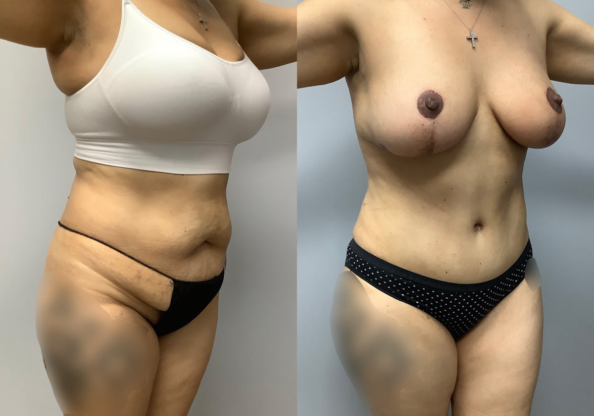 Tummy Tuck Before & After Gallery - Patient 147645231 - Image 2