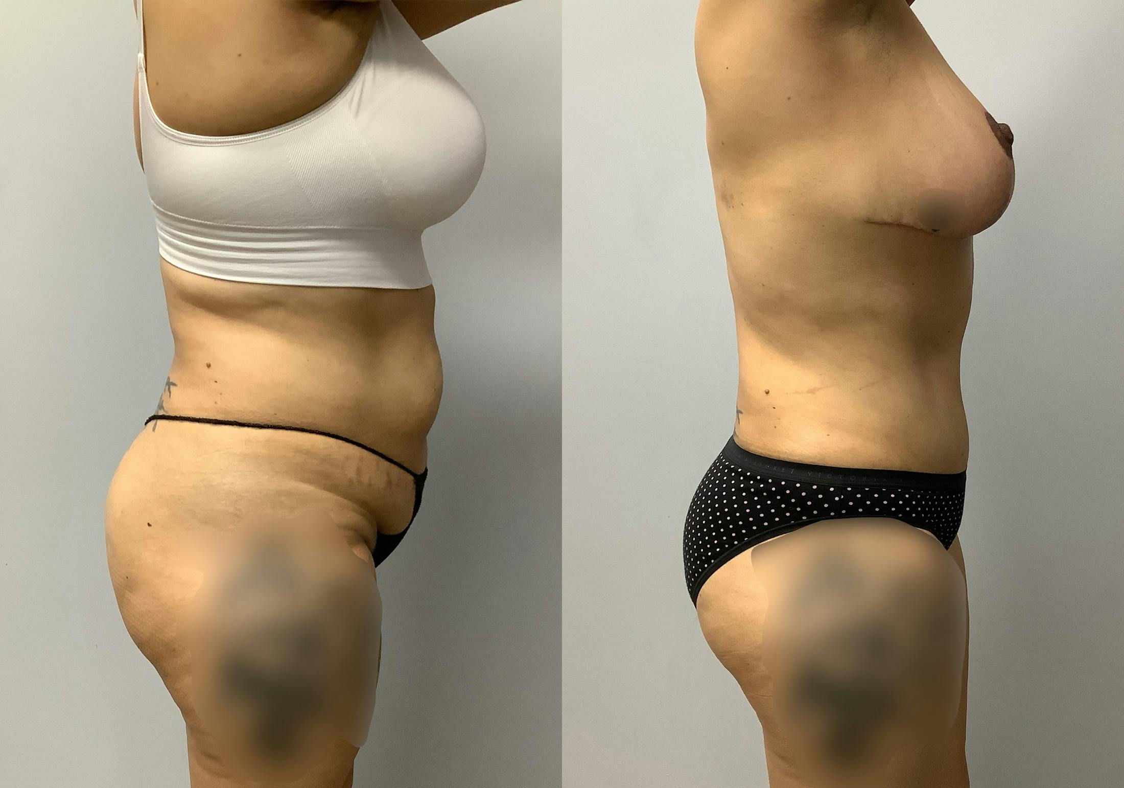 Tummy Tuck Before & After Gallery - Patient 147645231 - Image 3