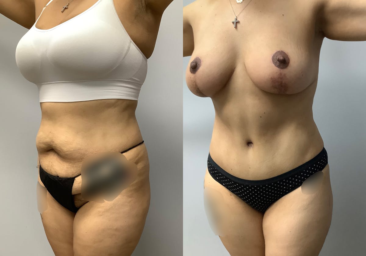 Tummy Tuck Before & After Gallery - Patient 147645231 - Image 4