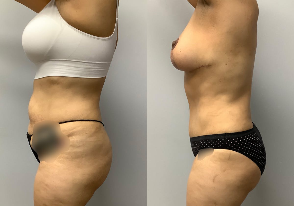 Tummy Tuck Before & After Gallery - Patient 147645231 - Image 5