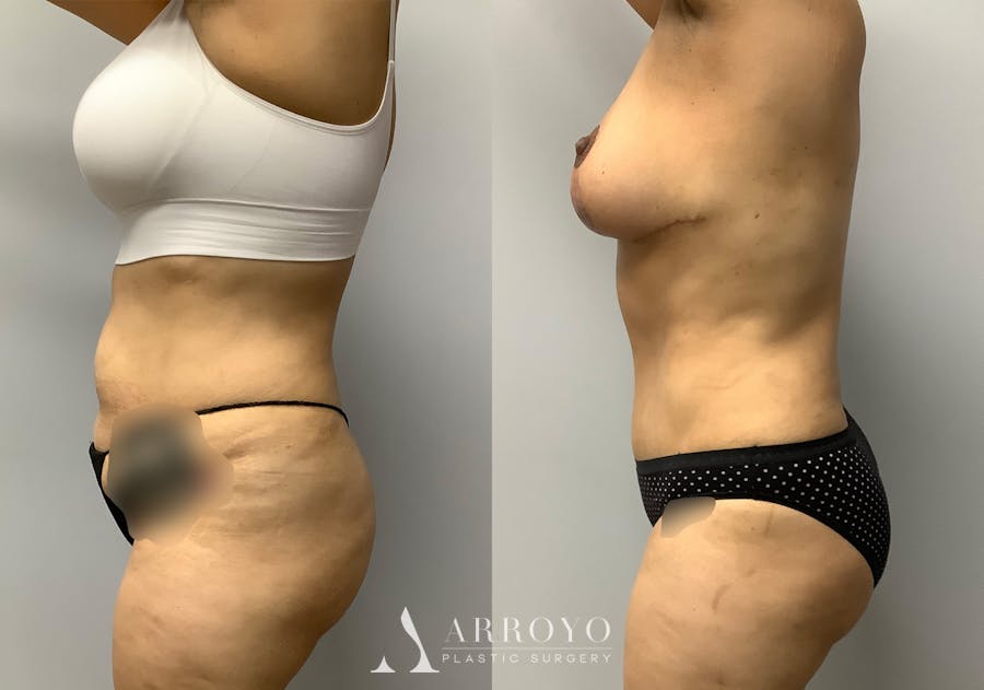 Tummy Tuck Before & After Gallery - Patient 147645231 - Image 5