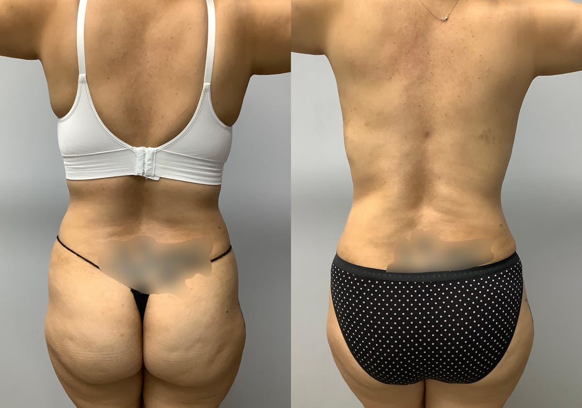 Tummy Tuck Before & After Gallery - Patient 147645231 - Image 6