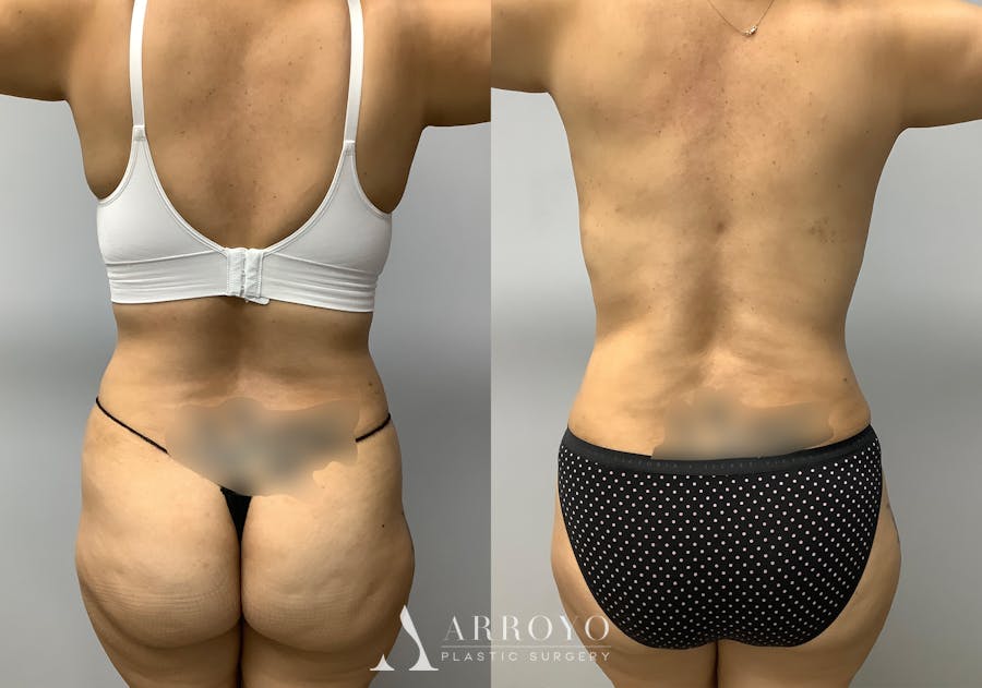 Tummy Tuck Before & After Gallery - Patient 147645231 - Image 6