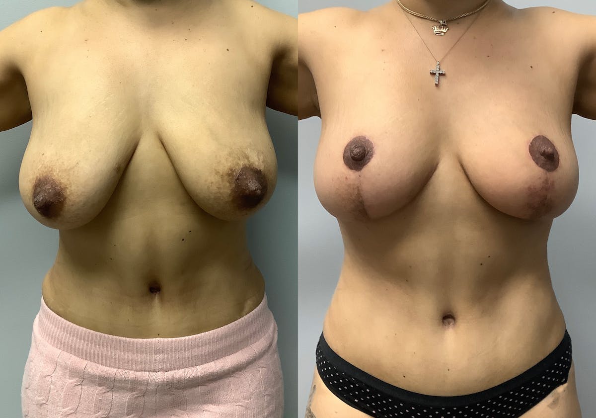 Breast Lift Before & After Gallery - Patient 147645281 - Image 1