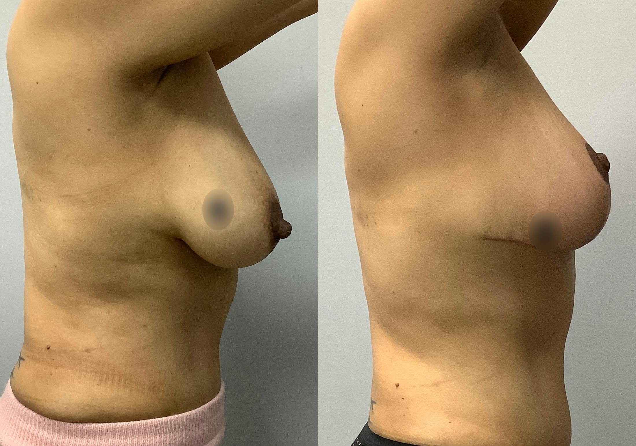 Breast Lift Before & After Gallery - Patient 147645281 - Image 3