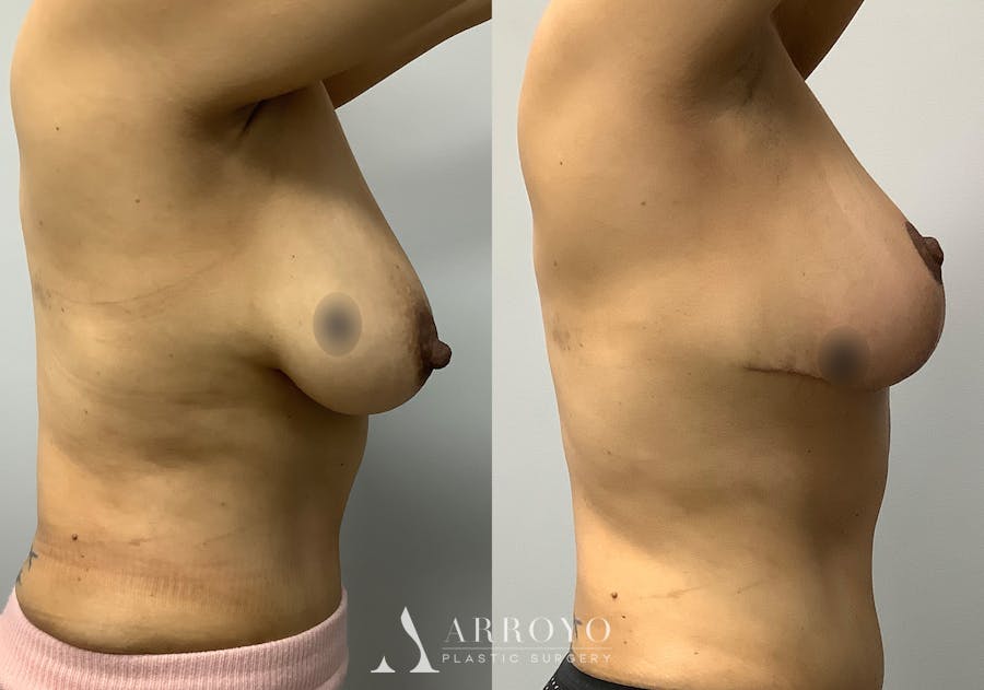 Breast Lift Before & After Gallery - Patient 147645281 - Image 3