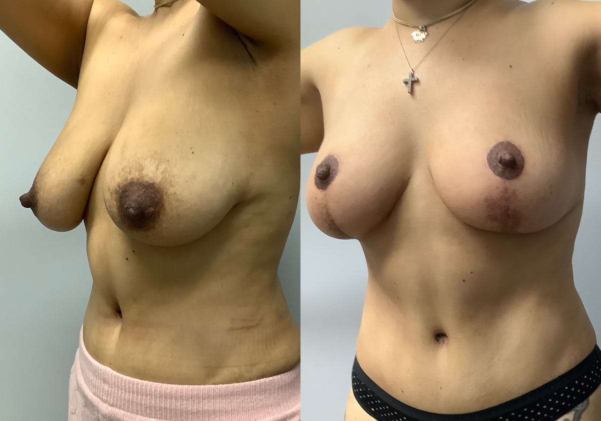 Breast Lift Before & After Gallery - Patient 147645281 - Image 4