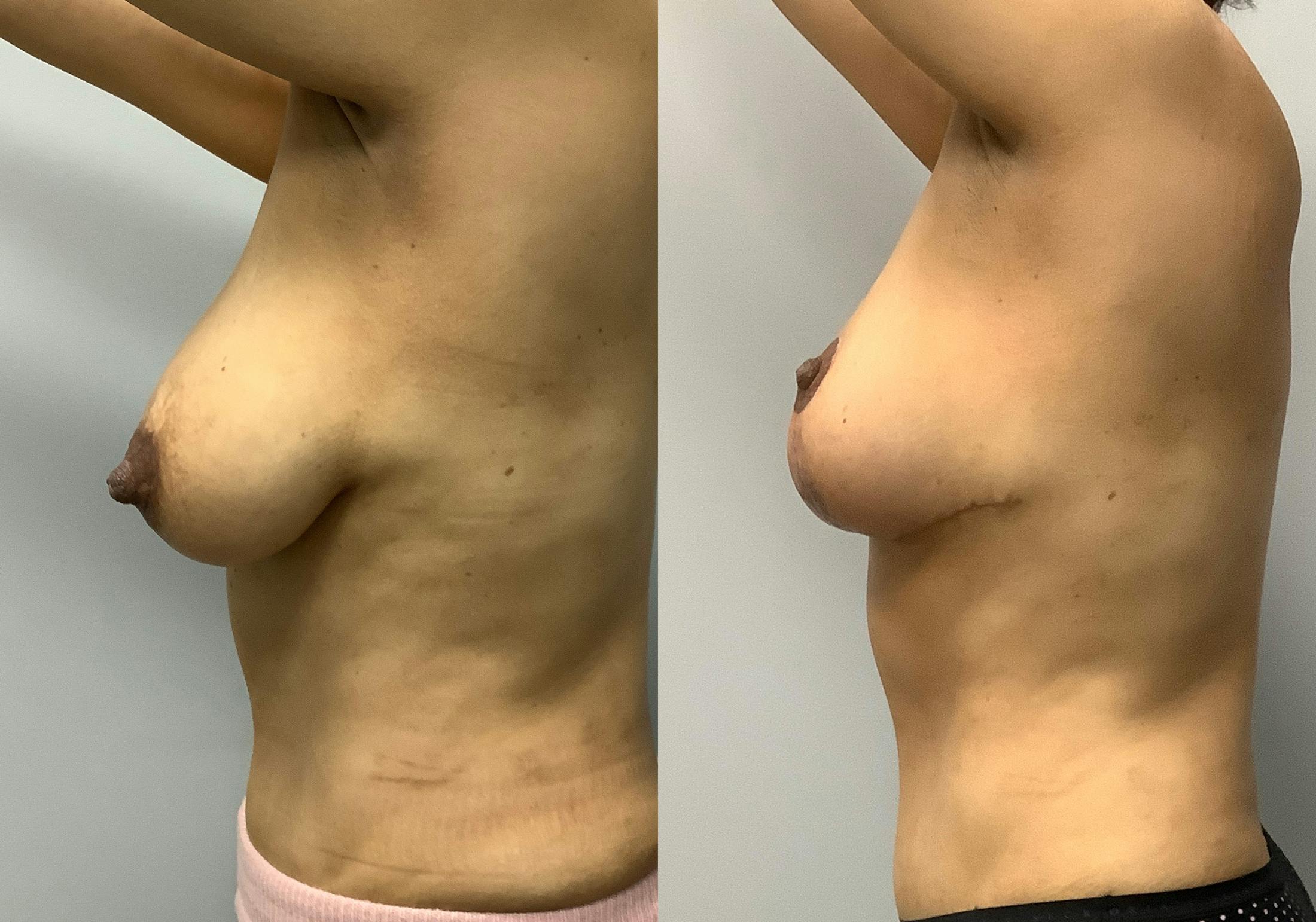 Breast Lift Before & After Gallery - Patient 147645281 - Image 5