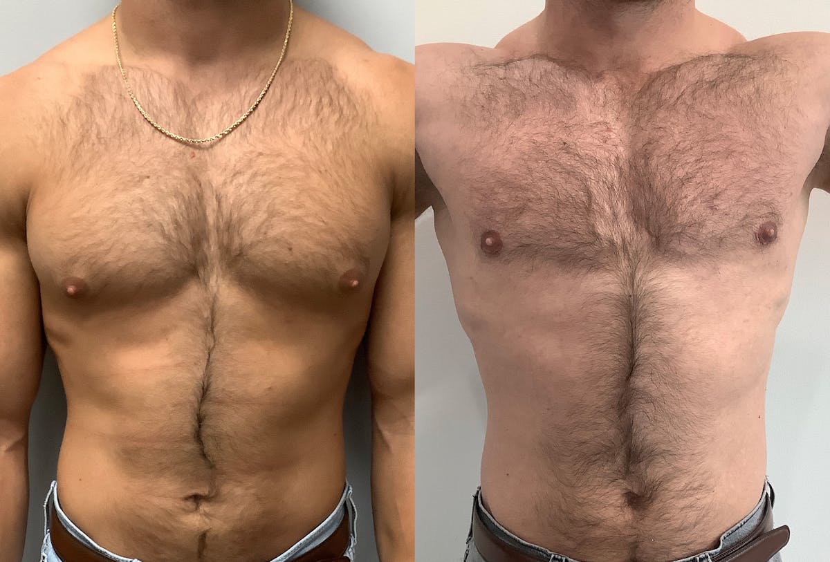 Gynecomastia Before & After Gallery - Patient 147667757 - Image 1