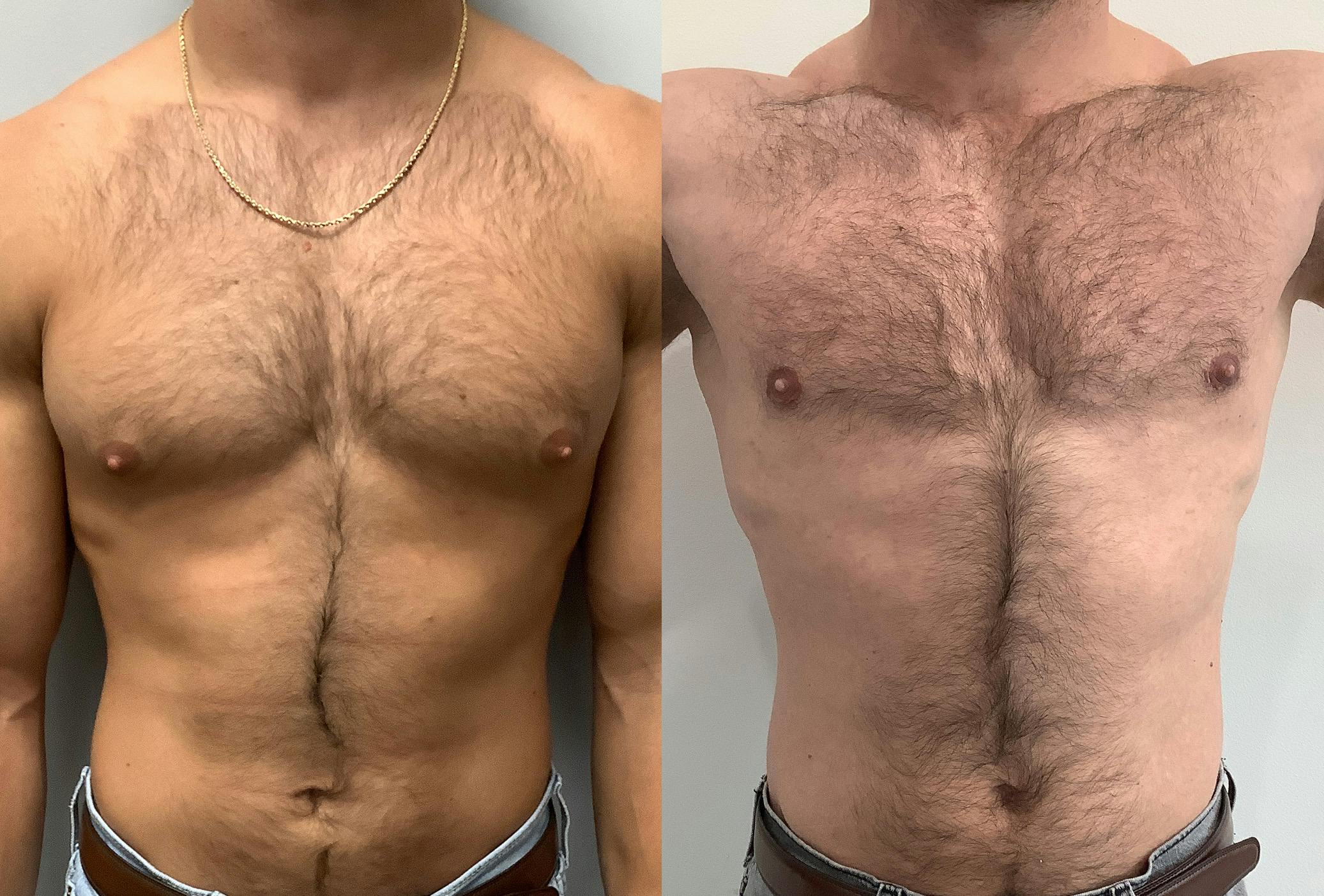Gynecomastia Before & After Gallery - Patient 147667757 - Image 1