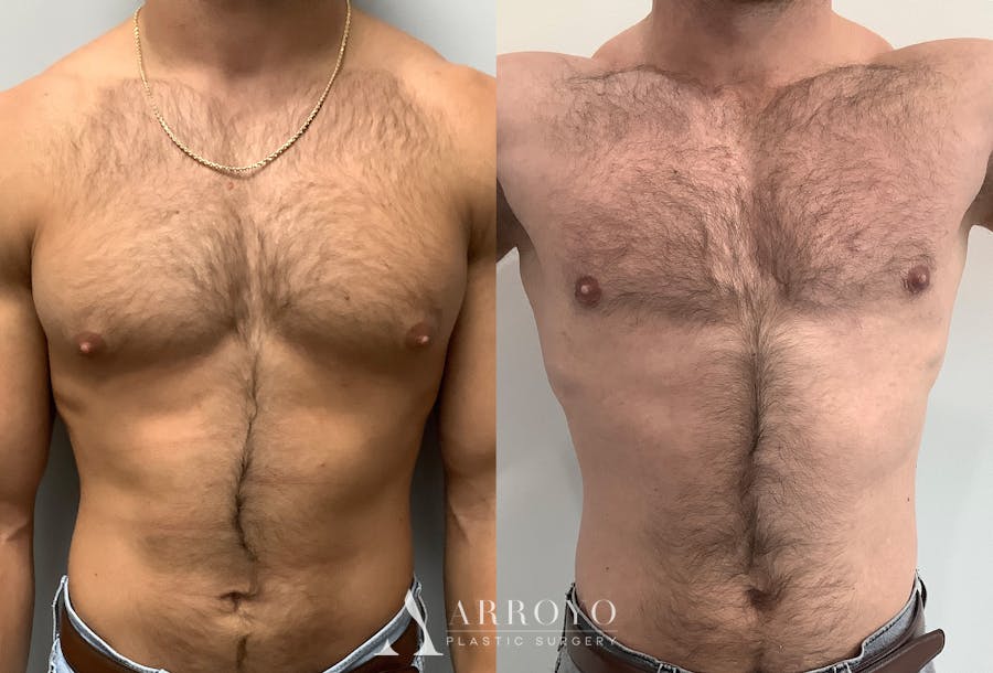 Gynecomastia Before & After Gallery - Patient 147667757 - Image 1