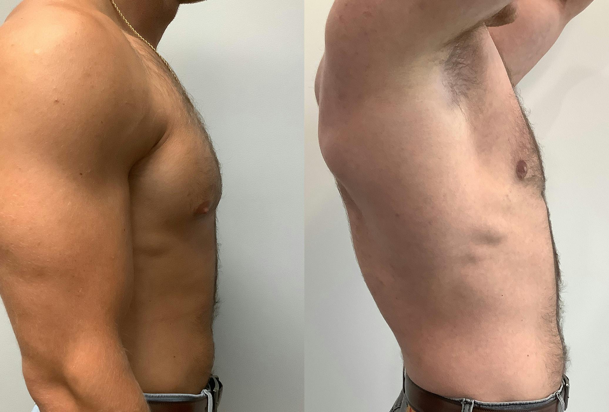 Gynecomastia Before & After Gallery - Patient 147667757 - Image 3