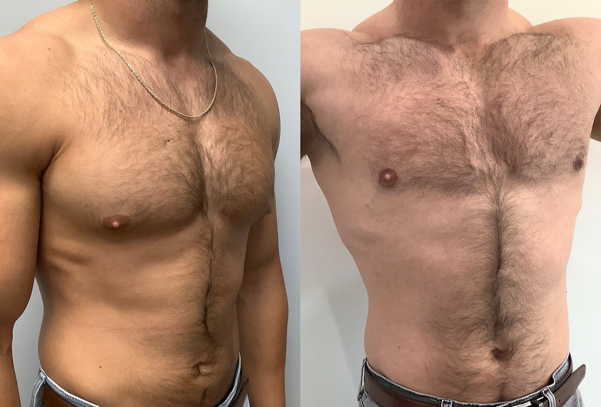 Gynecomastia Before & After Gallery - Patient 147667757 - Image 2
