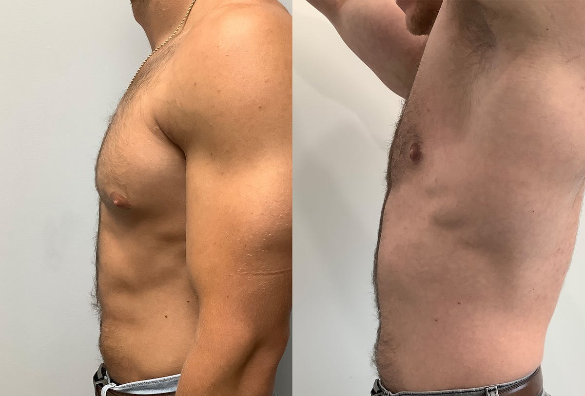 Gynecomastia Before & After Gallery - Patient 147667757 - Image 5
