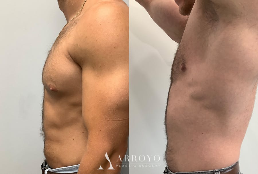 Gynecomastia Before & After Gallery - Patient 147667757 - Image 5