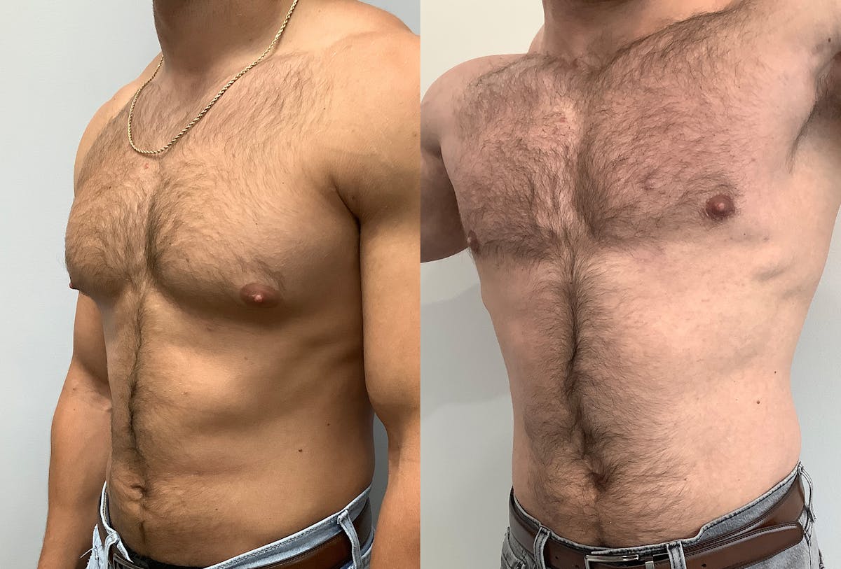 Gynecomastia Before & After Gallery - Patient 147667757 - Image 4