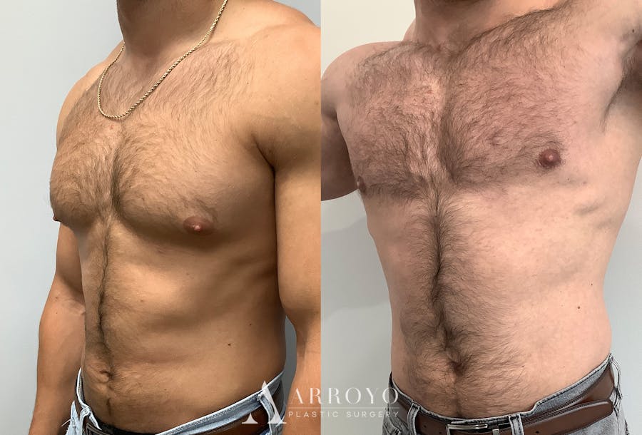 Gynecomastia Before & After Gallery - Patient 147667757 - Image 4