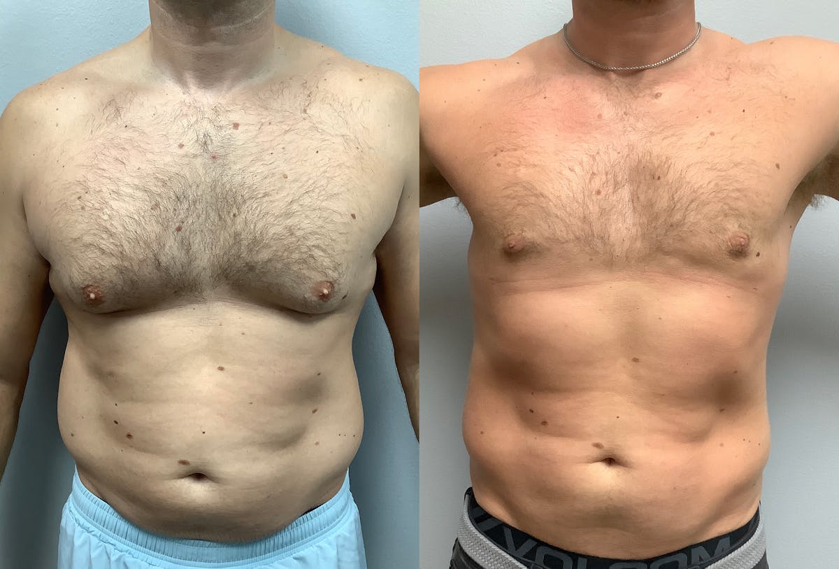 Gynecomastia Before & After Gallery - Patient 147667758 - Image 1