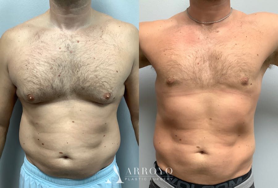Gynecomastia Before & After Gallery - Patient 147667758 - Image 1