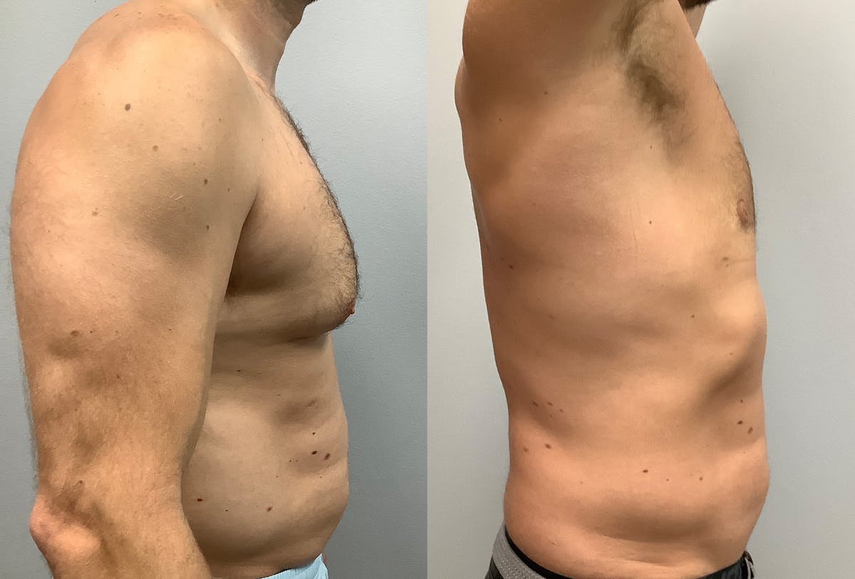Gynecomastia Before & After Gallery - Patient 147667758 - Image 3