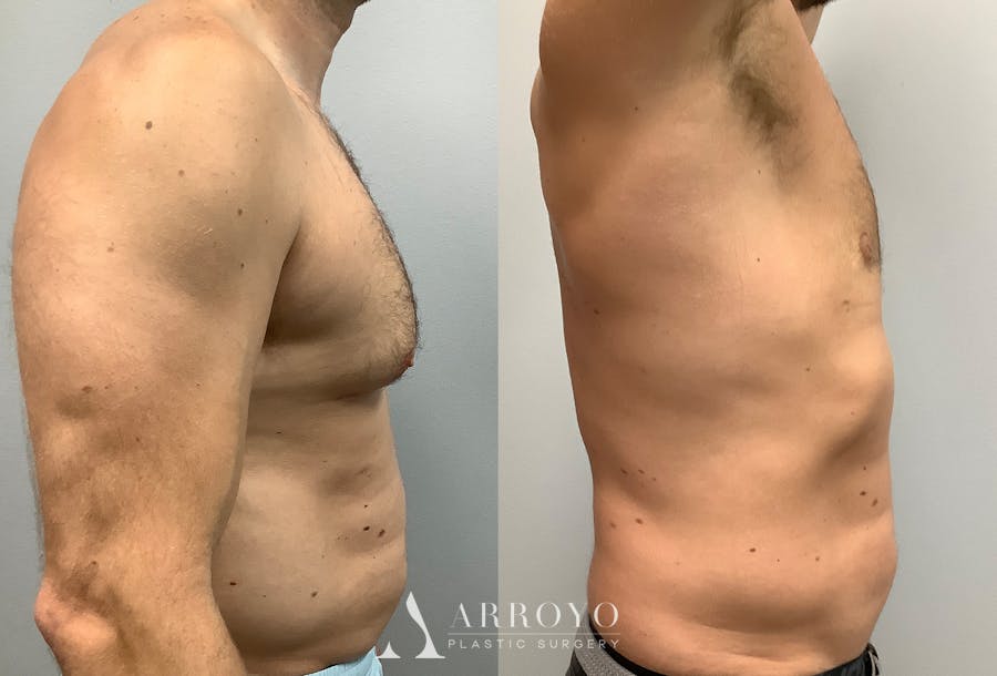 Gynecomastia Before & After Gallery - Patient 147667758 - Image 3