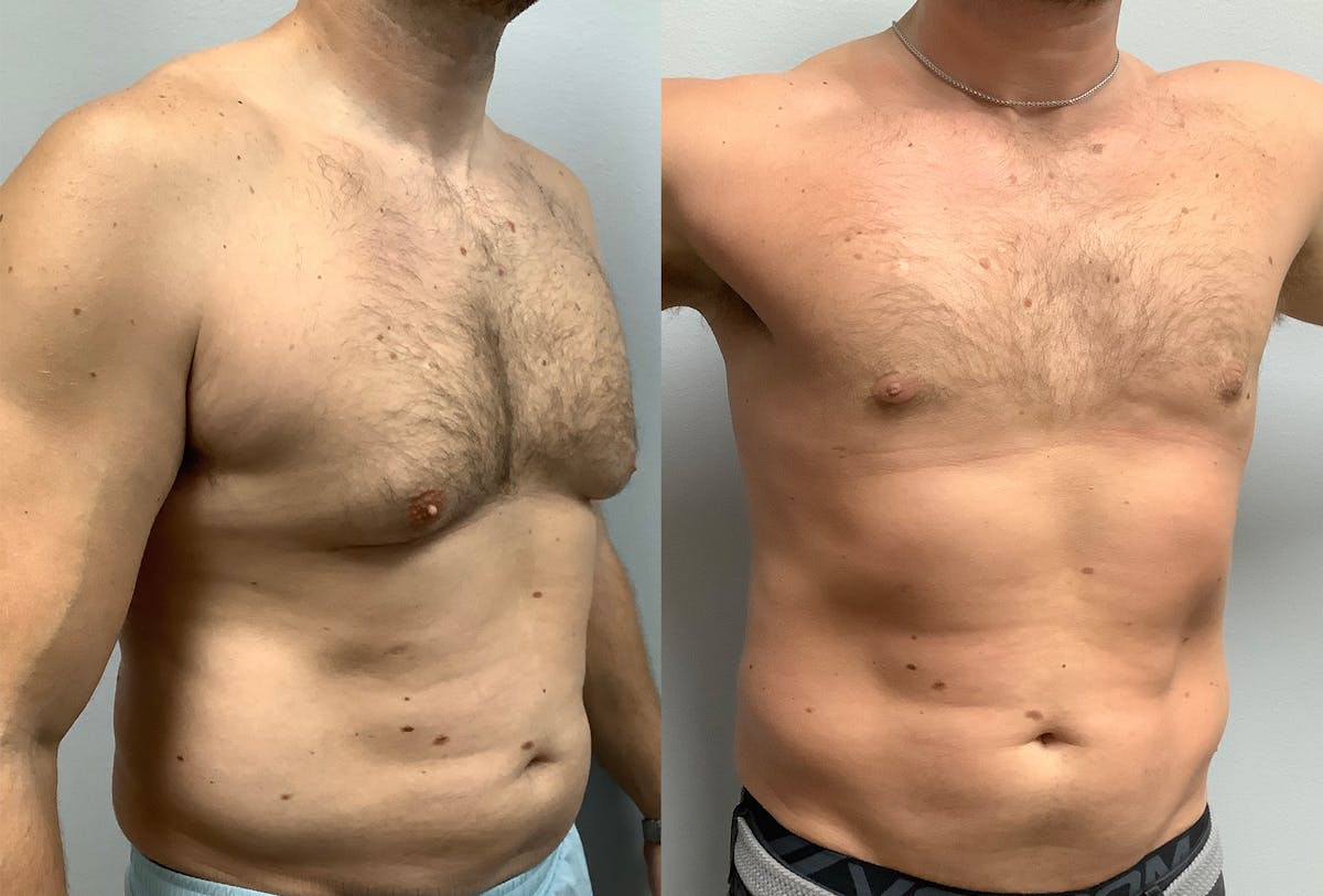 Gynecomastia Before & After Gallery - Patient 147667758 - Image 2