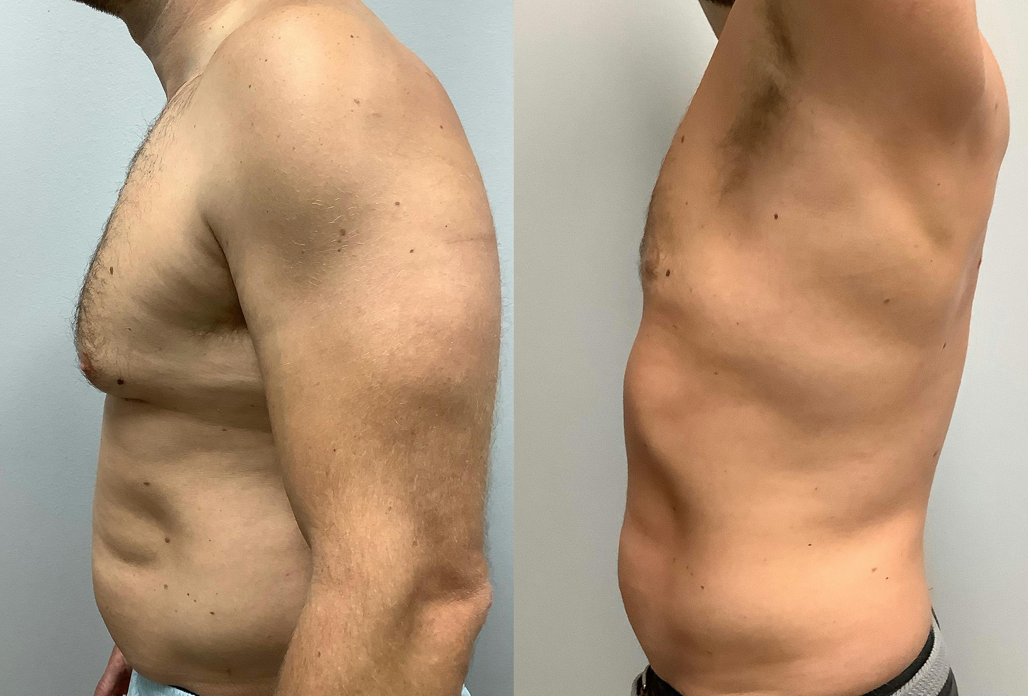 Gynecomastia Before & After Gallery - Patient 147667758 - Image 5