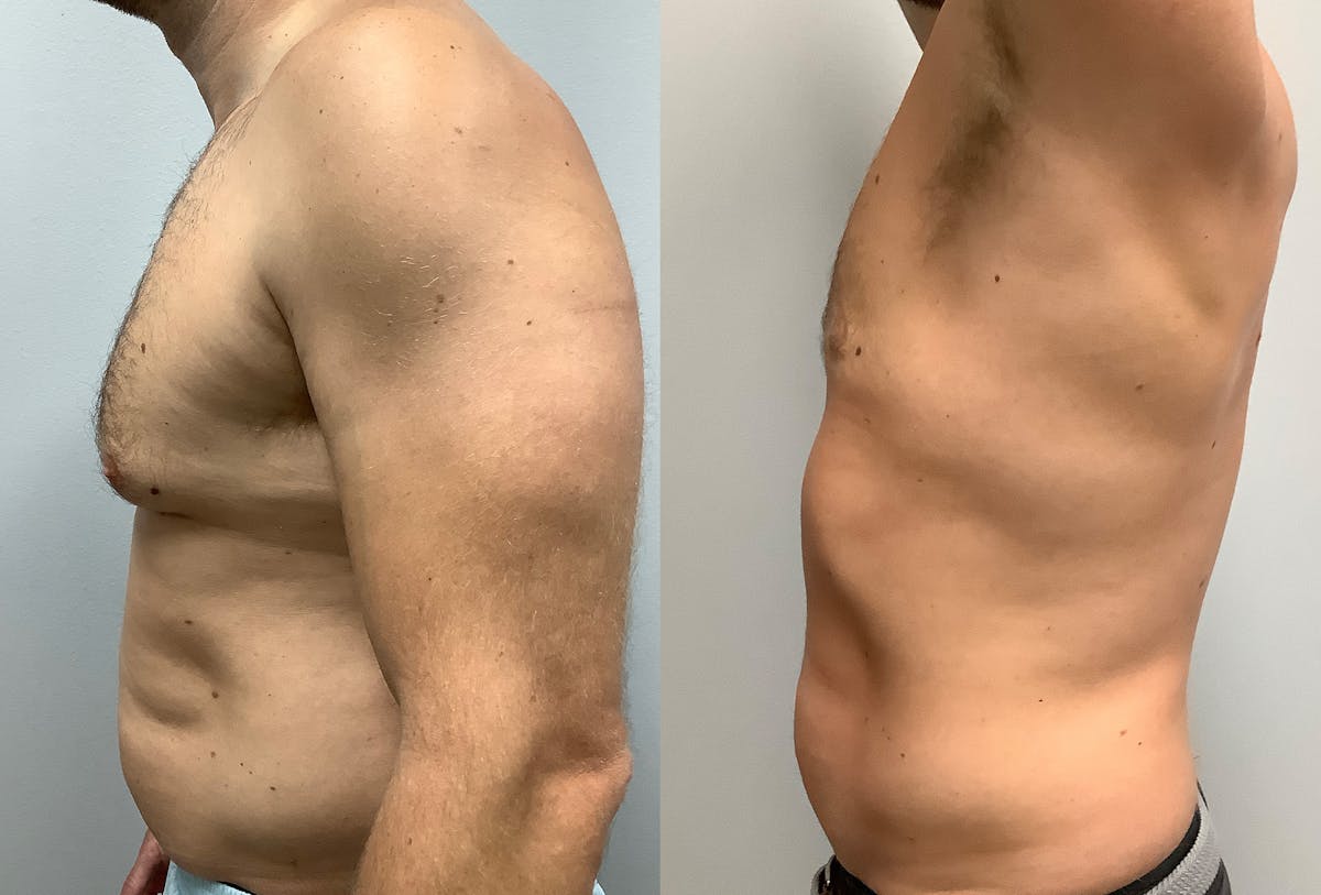 Gynecomastia Before & After Gallery - Patient 147667758 - Image 5