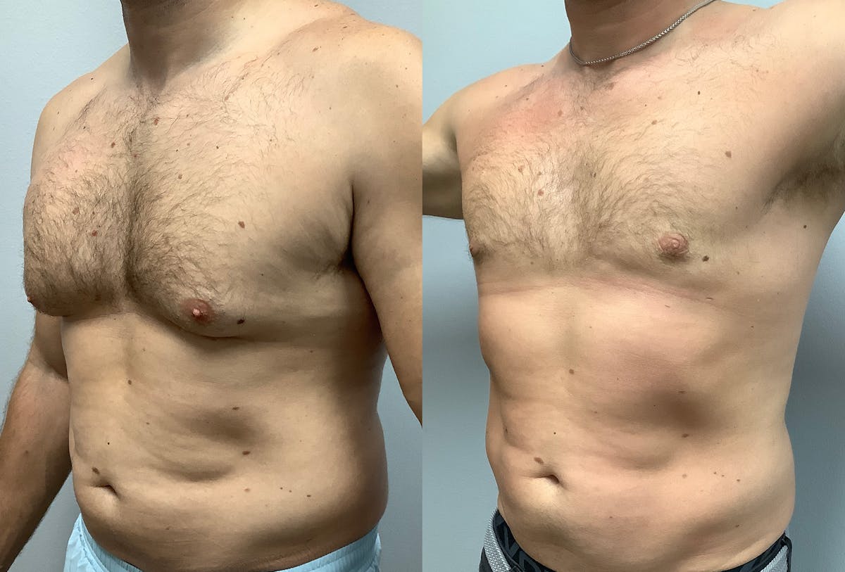 Gynecomastia Before & After Gallery - Patient 147667758 - Image 4