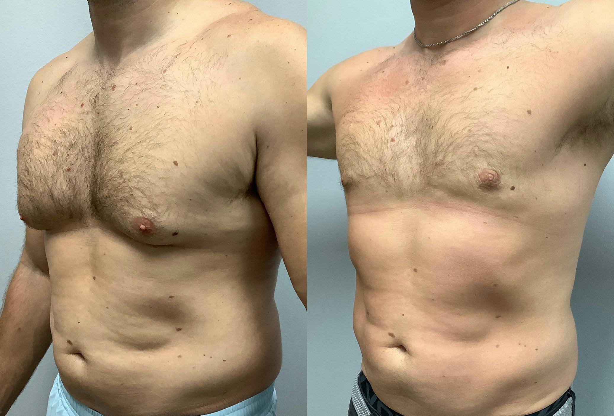 Gynecomastia Before & After Gallery - Patient 147667758 - Image 4