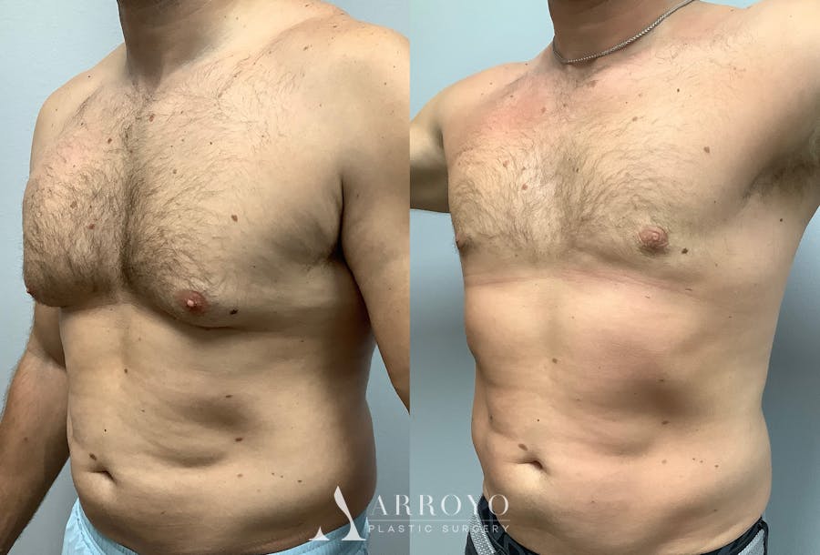 Gynecomastia Before & After Gallery - Patient 147667758 - Image 4