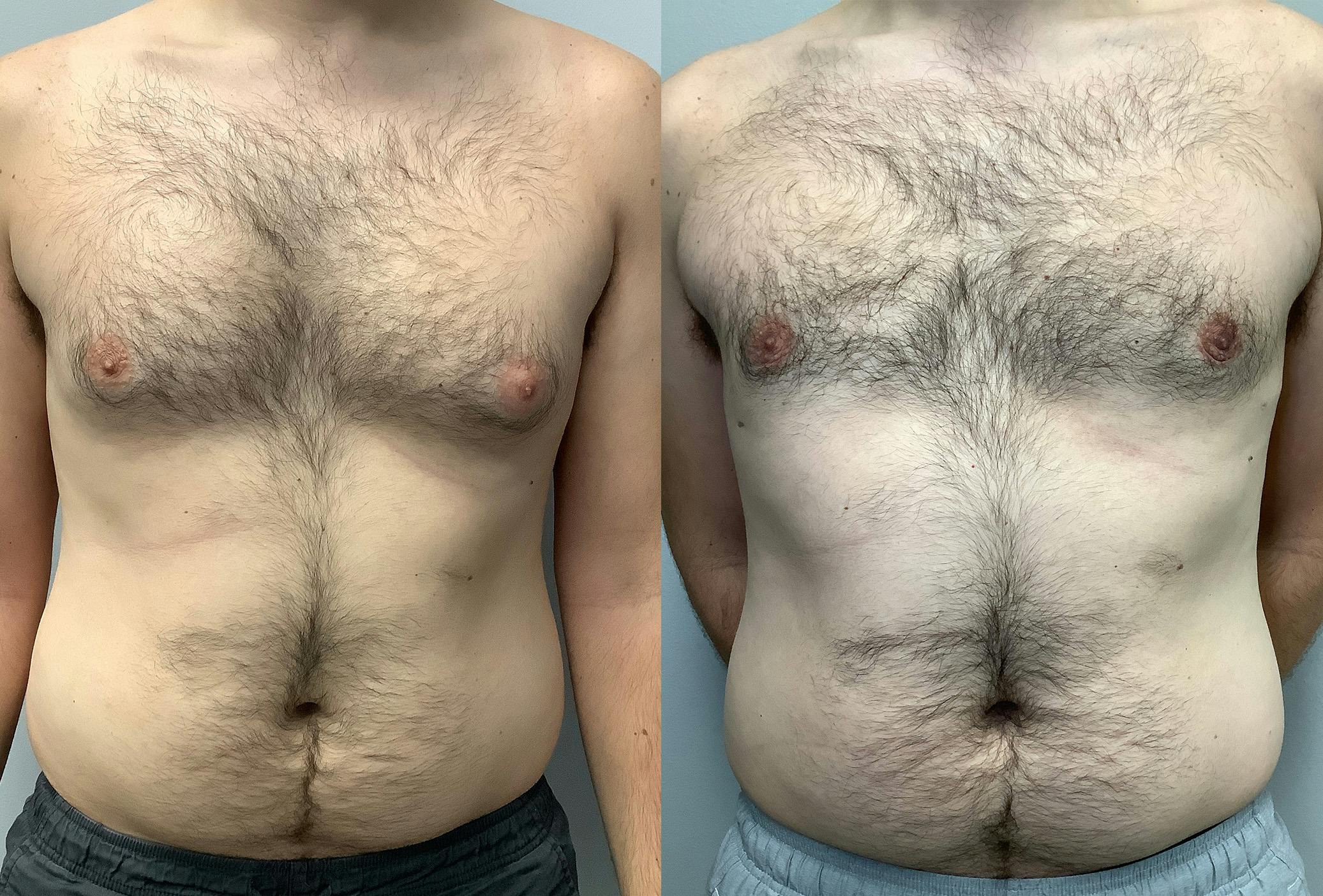 Before and After Male Breast Reduction in Houston - 02