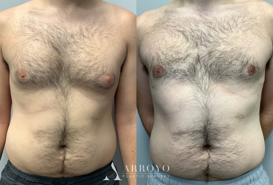 Gynecomastia Before & After Gallery - Patient 147667759 - Image 1