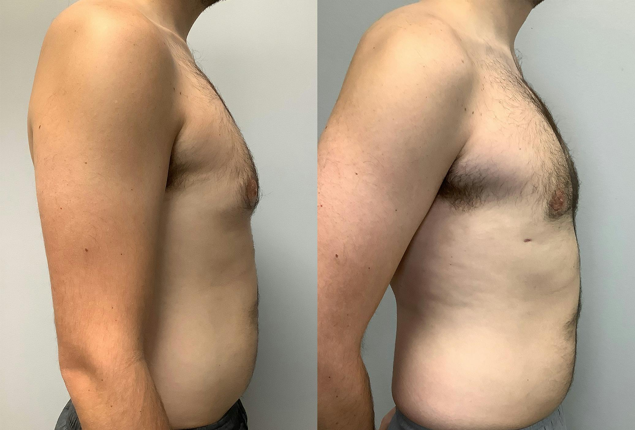 Gynecomastia Before & After Gallery - Patient 147667759 - Image 3