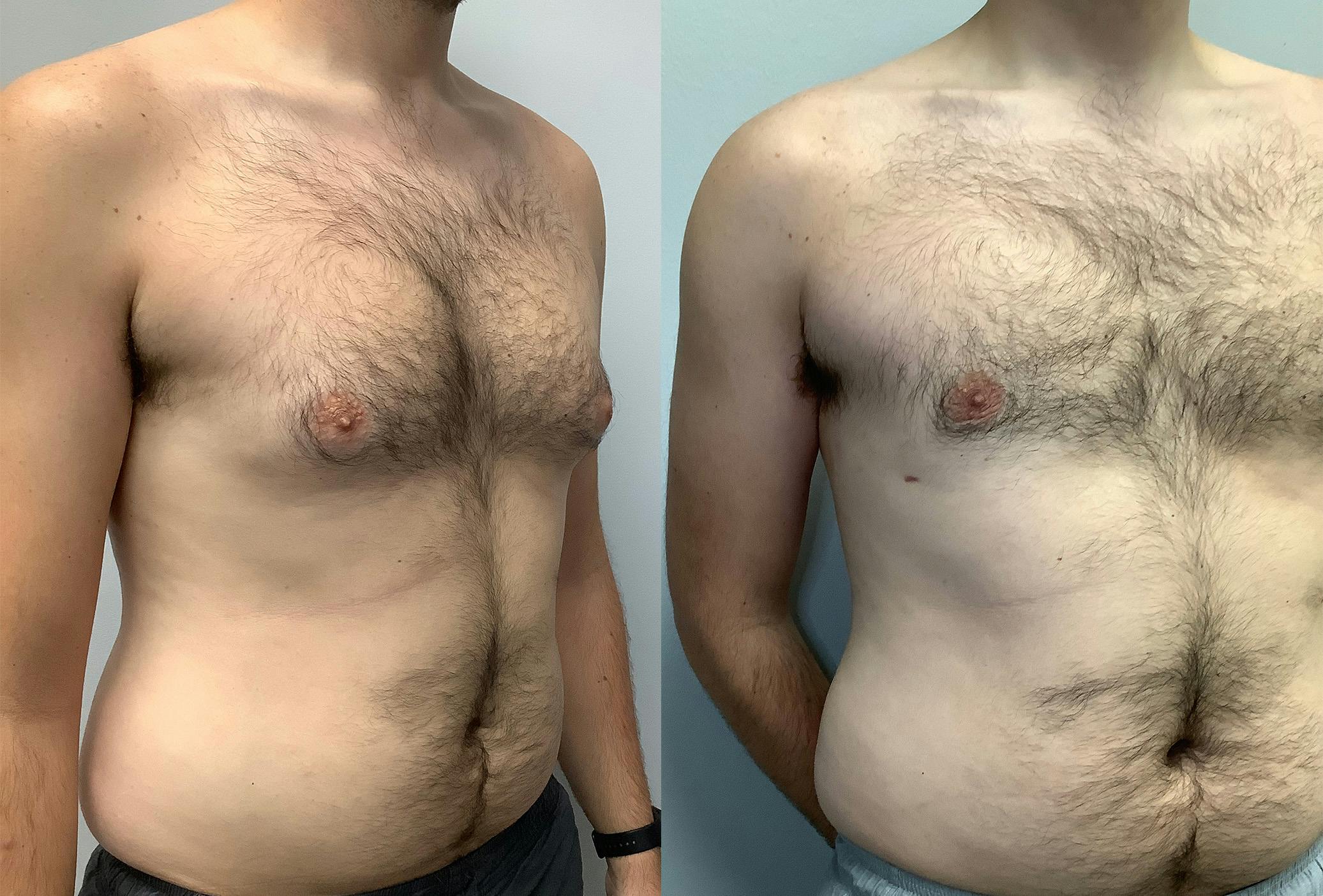 Gynecomastia Before & After Gallery - Patient 147667759 - Image 2