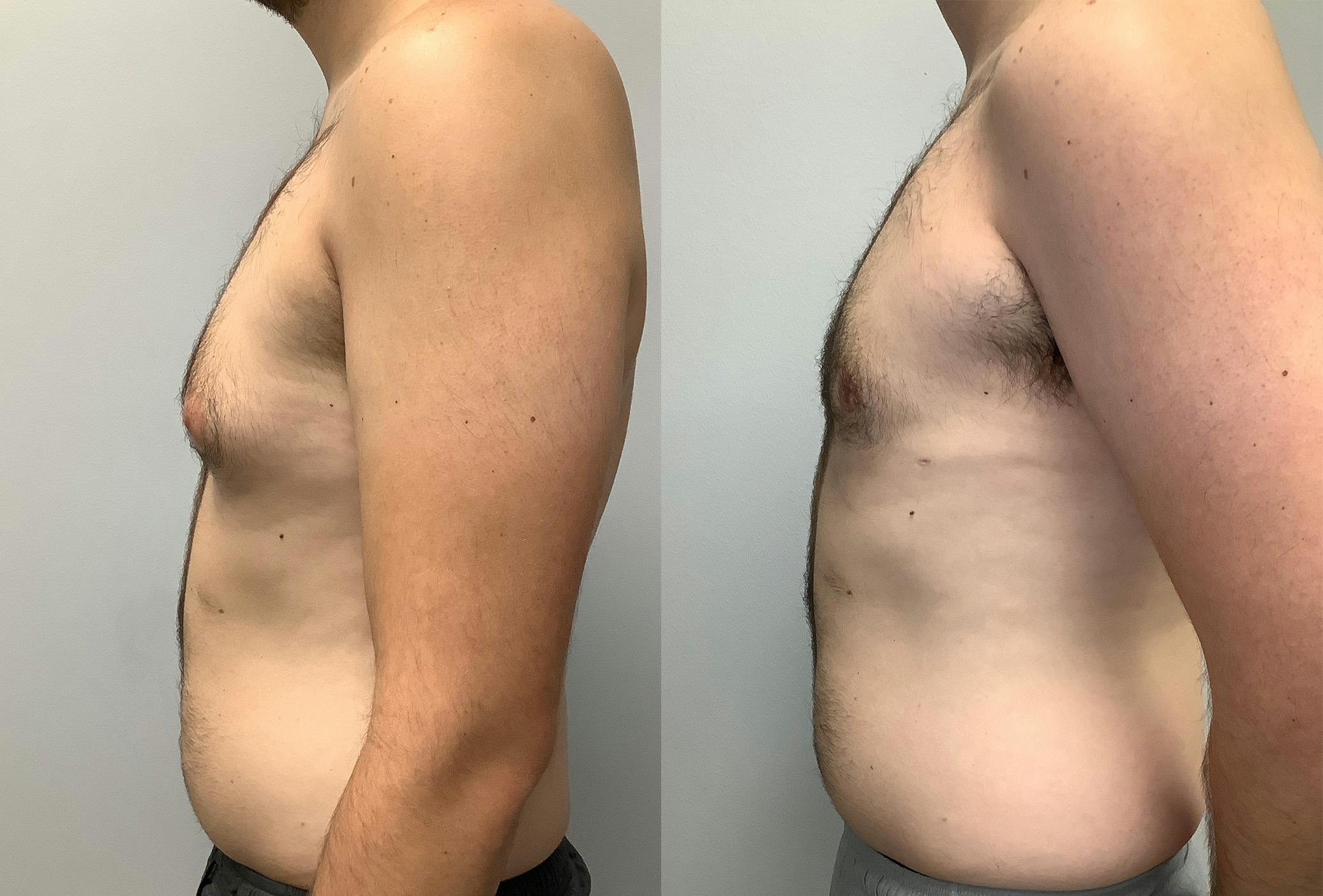 Gynecomastia Before & After Gallery - Patient 147667759 - Image 5