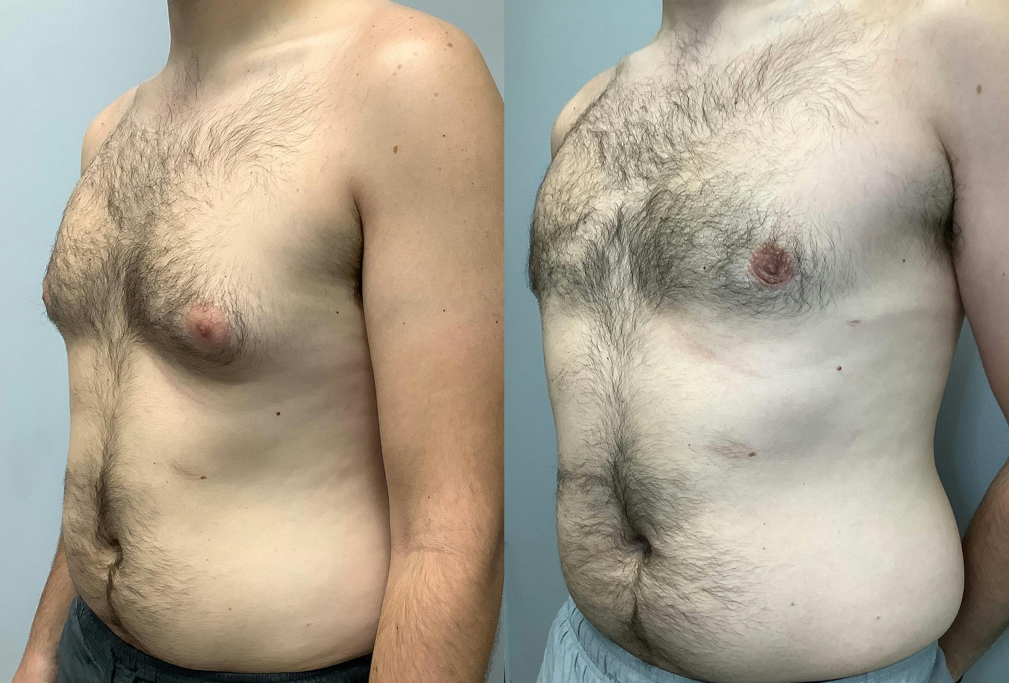 Before and After Male Breast Reduction in Houston - 02