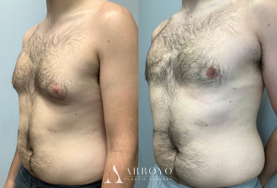 Gynecomastia Before & After Gallery - Patient 147667759 - Image 4