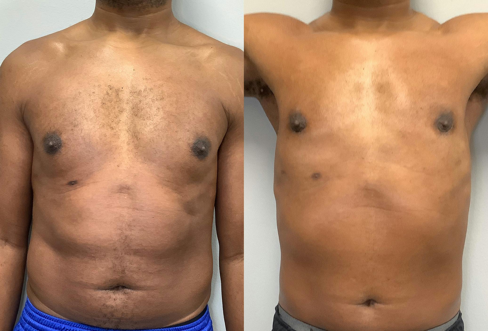Gynecomastia Before & After Gallery - Patient 147667761 - Image 1