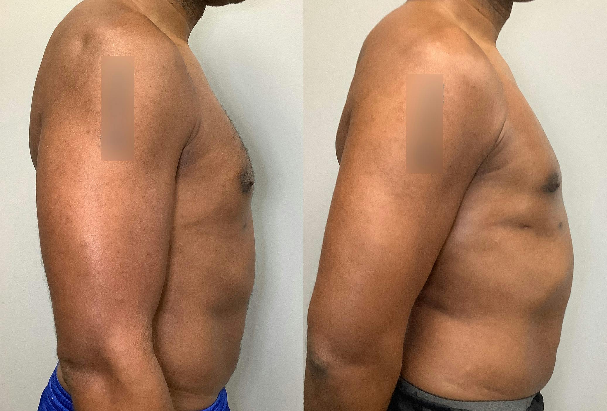 Gynecomastia Before & After Gallery - Patient 147667761 - Image 3