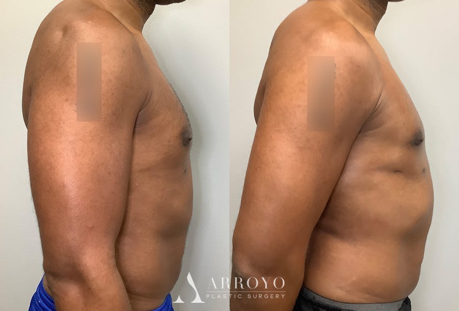 Gynecomastia Before & After Gallery - Patient 147667761 - Image 3