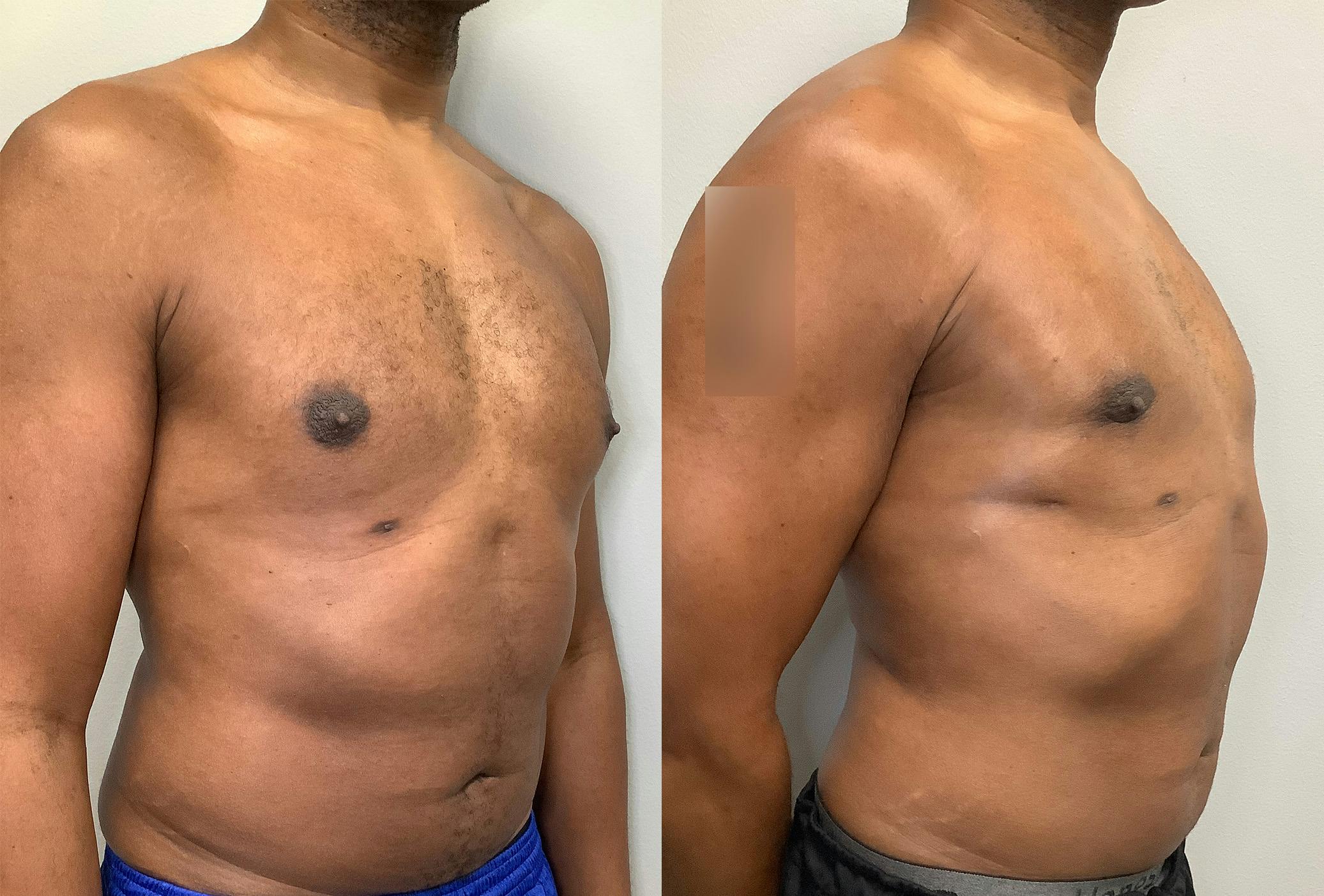 Gynecomastia Before & After Gallery - Patient 147667761 - Image 2