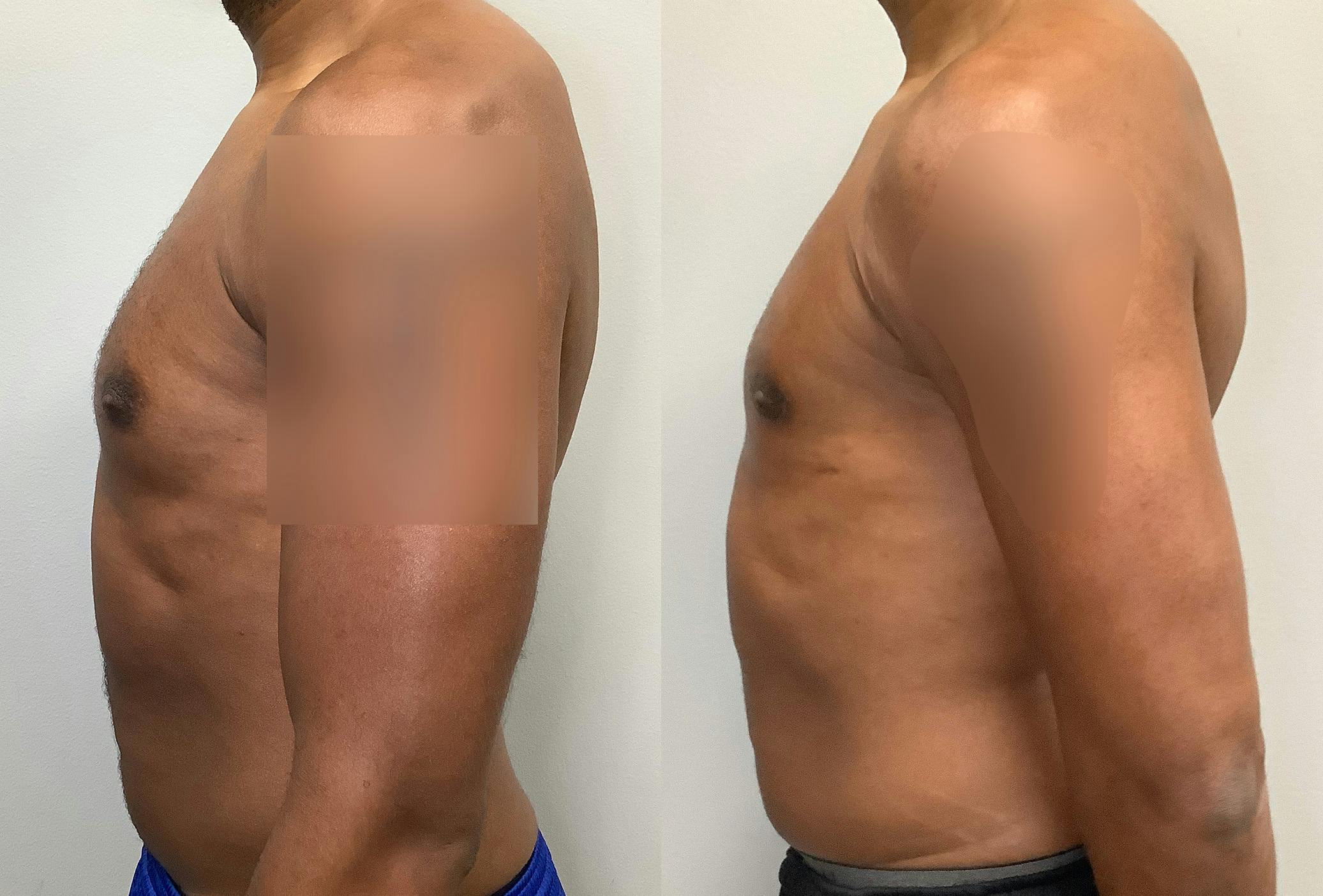 Gynecomastia Before & After Gallery - Patient 147667761 - Image 5