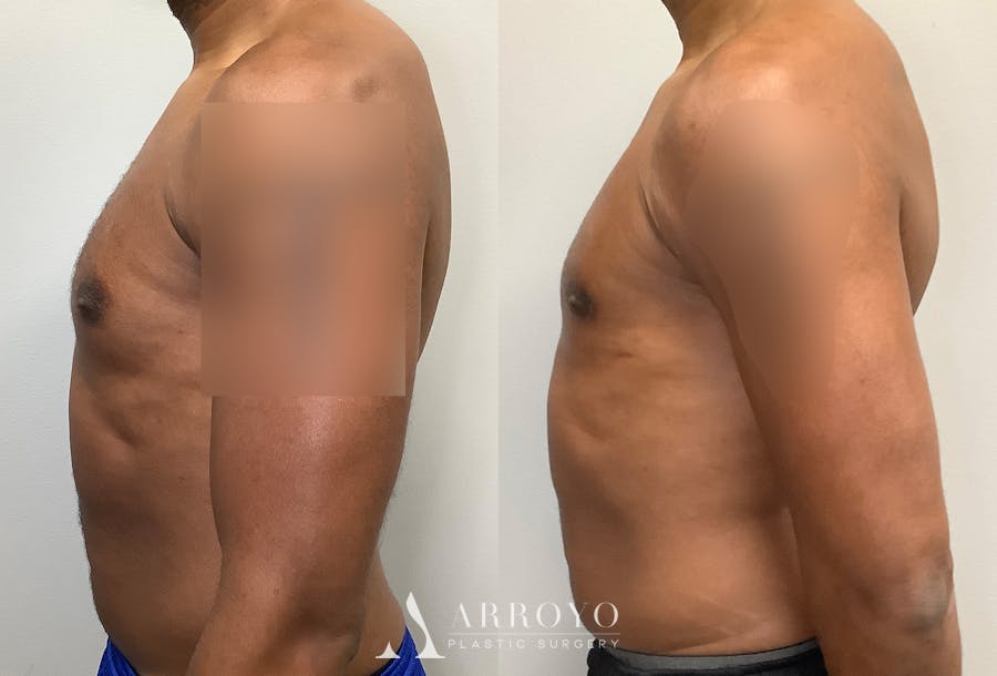 Gynecomastia Before & After Gallery - Patient 147667761 - Image 5