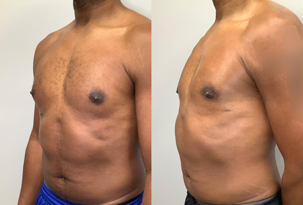Gynecomastia Before & After Gallery - Patient 147667761 - Image 4