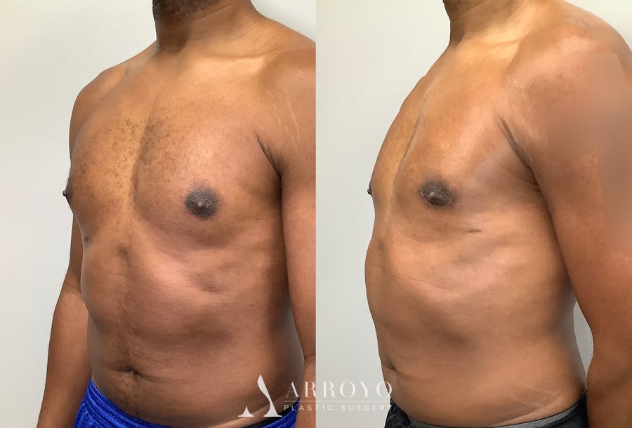 Gynecomastia Before & After Gallery - Patient 147667761 - Image 4