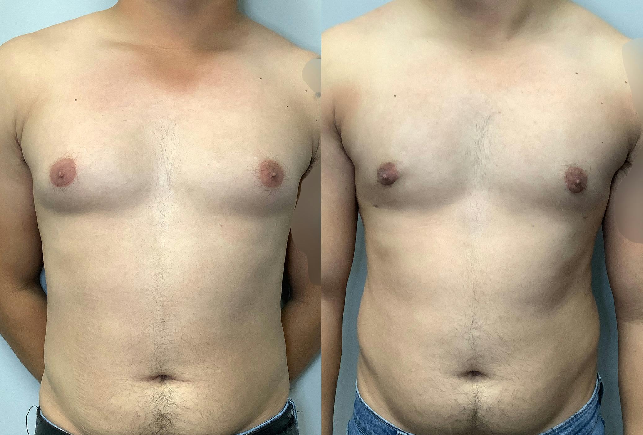 Gynecomastia Before & After Gallery - Patient 147667763 - Image 1